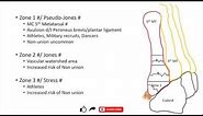Jones fracture and Pseudo-Jones fracture ; differences