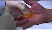Percutaneous Trigger Finger Release : Donald Ditmars MD, FACS