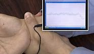 Wearable Laser Blood Flowmeter