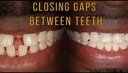 Closing Gaps Between Teeth With Braces