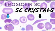 SC Crystals/Cells in Hemoglobin SC Disease (combo of Sickle Cell Anemia Hemoglobin S & Hemoglobin C)