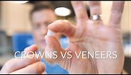CROWNS VS VENEERS - Which is best?