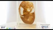 Ovary: Mucinous cystadenocarcinoma