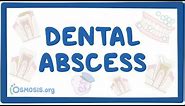 Dental abscess - causes, symptoms, diagnosis, treatment, pathology