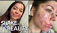 Doctors Told Me I Had The Worst Acne They’d Ever Seen | SHAKE MY BEAUTY