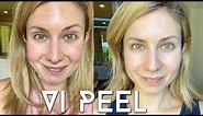 Vi PEEL done at Home | Step by Step Process + Before and Afters