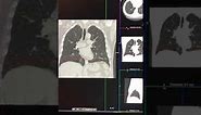 CT lung nodule assessment - how to assess them - basics