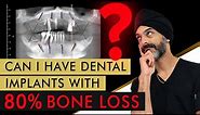 Can you have Dental Implants with 80% Bone Loss