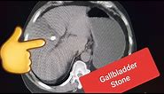 CT of the Gallbladder -Gallbladder stone @RadiologyChannel @RadiologyVideo