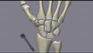 Scaphoid Fractures