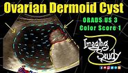 Ovarian Dermoid Cyst | Mature Cystic Teratoma | ORADS 3 || Ultrasound || Case 295