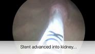 Placement of a ureteral stent