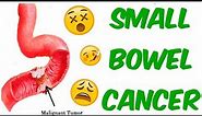 Intestinal Cancer (Small Bowel Adenocarcinomas, Sarcomas, Carcinoids, GISTs And Lymphomas)