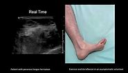 Dynamic ultrasound imaging of peroneus longus muscle herniation