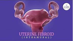 Uterine fibroids: 5 signs you should never ignore | Treatment Options for Uterine Fibroids