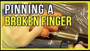 Fixing A Finger Fracture With Pins