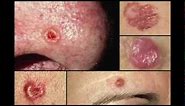 Some Basal Cell Skin Cancers Aggressive