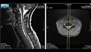 Normal Cervical Spine MRI Explained | Dr. Jeffrey P.Johnson | HD