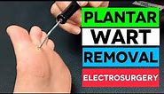 FAST Plantar Wart Removal By Electrosurgery