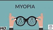 Myopia, Signs and Symptoms, Causes, Diagnosis and Treatment.