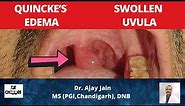 Swelling of uvula | Quincke Edema | Angioneurotic oedema | Uvula Functions | Causes | Management