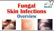 Overview of Fungal Skin Infections | Tinea Infections