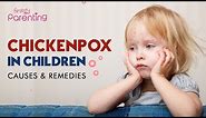 Chickenpox In Children - Causes, Signs & Treatment