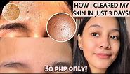 HOW TO GET RID OF TINY BUMPS ON FOREHEAD/FACE FAST | FUNGAL ACNE (how i cleared my skin) [ENG SUB]