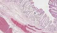 Histopathology Colon--Tubular adenoma (adenomatous polyp)
