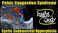 Pelvic Congestion Syndrome & Endometrial Cystic Hyperplasia || Ultrasound || Doppler || Case 90