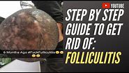 Step by step guide to get rid of folliculitis