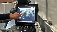 Medical student helps discover her own cancer in ultrasound class