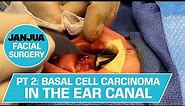 PART 2: BASAL CELL CARCINOMA IN THE EAR CANAL - DR. TANVEER JANJUA - NEW JERSEY