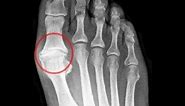 Big Toe Joint Pain Causes [Home Treatment Guide]