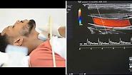 Carotid and Vertebral Arteries Doppler Ultrasound Protocols