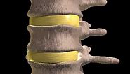 How Slipped Discs Happen Animation What’s Herniation - Herniated Nucleus Pulposus Bulging Disc Video