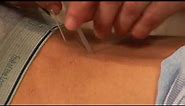 Acupuncture as Treatment for Back Pain