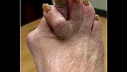 Ugly Feet - Watch if you dare!