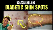 Doctor explains DIABETIC DERMOPATHY (AKA DIABETIC SHIN SPOTS) – plus causes and prevention