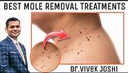 Effective Ways To Remove Moles Naturally | Every Thing about Removing Moles