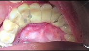 Houston Cosmetic Dentist...Worst Tartar I have seen! Watch how we remove it...