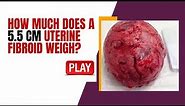 How Much does a 5.5 CM Uterine Fibroid Weigh? [Learn More]