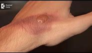 How to treat a burn blister at home? Tips to avoid burn scar - Dr. Pavan Murdeshwar
