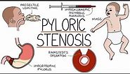 Understanding Pyloric Stenosis