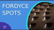 Fordyce Spots: Oil Glands or Warts?