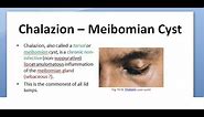 Ophthalmology 376 Chalazion Meibomian Cyst triamcinolone DIATHERMY tetracycline MALIGNANCY Eyelid