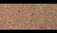 Blast cells in peripheral blood smear