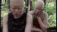 Deadly Hunt: Albinos in Tanzania