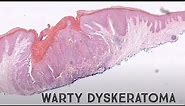 Warty Dyskeratoma (acantholytic dyskeratosis pathology dermpath dermatology dermatopathology)