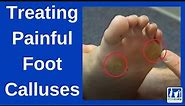 How to Treat Painful Foot Calluses